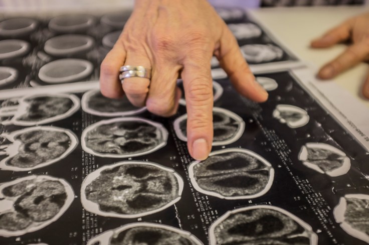 Angela Rocha, 67, infectologist at the Oswaldo Cruz hospital in Recife, Pernambuco, showing a brain tomography of an infant with microcephaly